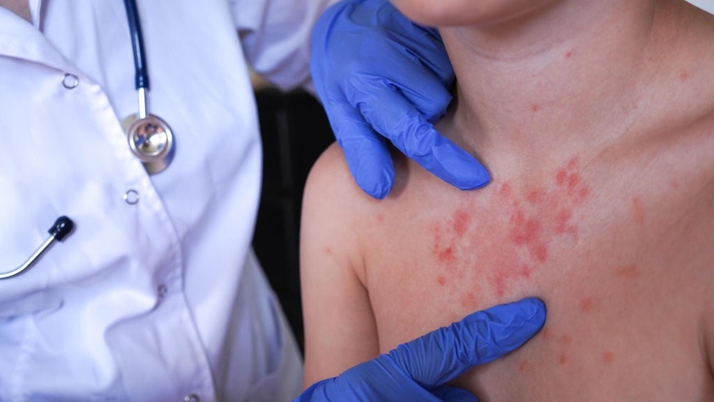 Minnesota's 80 measles cases this year are the most since 1990, health officials say — Chanhassen Health news