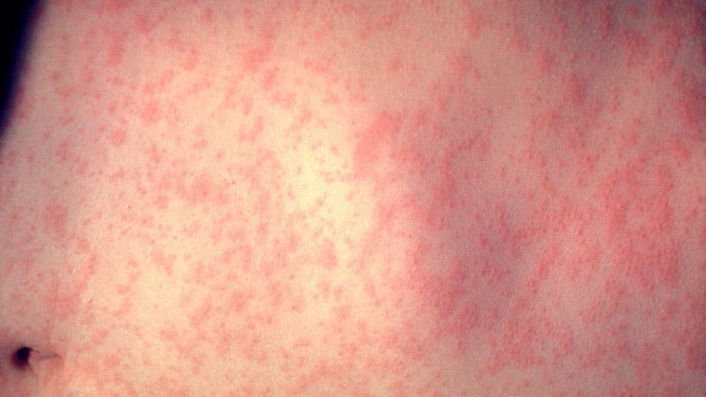 25 cases of measles identified in central, southeastern Minnesota, MDH says — WCCO / CBS Minnesota, Chanhassen Health news